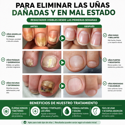 PureNail - Suero para tratamiento de uñas con hongos en 7 días